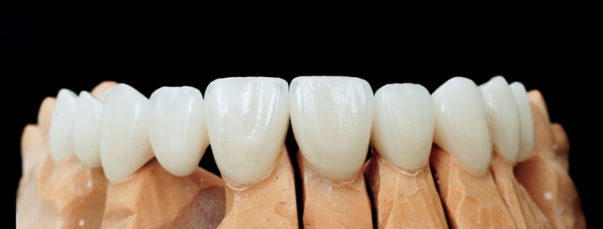 Appareil provisoire ou définitif comparaison