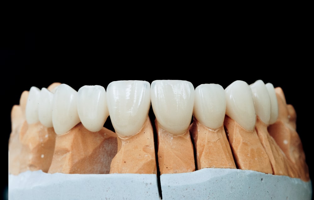 Couronne dentaire: une prothèse qui remplace la partie visible de la dent