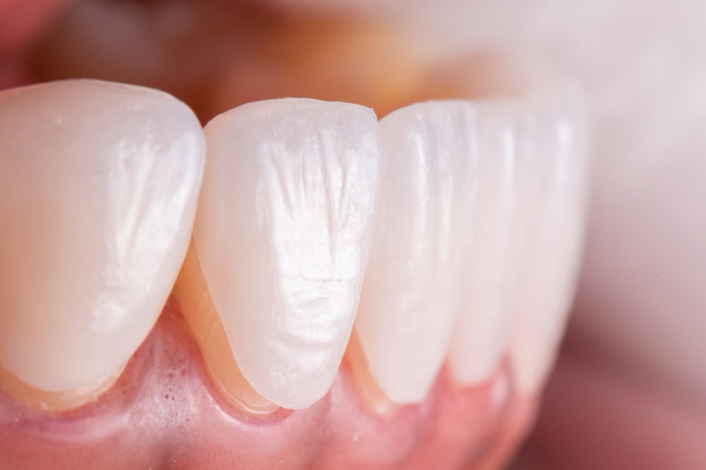Appareil dentaire provisoire ou définitif : quelles sont les différences ?