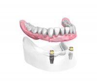 Appareil complet sur 2 implants dentaires et 2 boutons