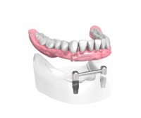 appareil complet sur 2 implants dentaires