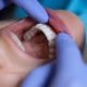 cément dentaire : rôle et pathologies courantes