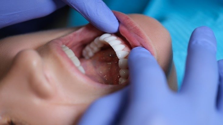 cément dentaire : rôle et pathologies courantes
