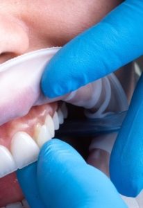 Prévention et traitement des troubles associés au cément dentaire