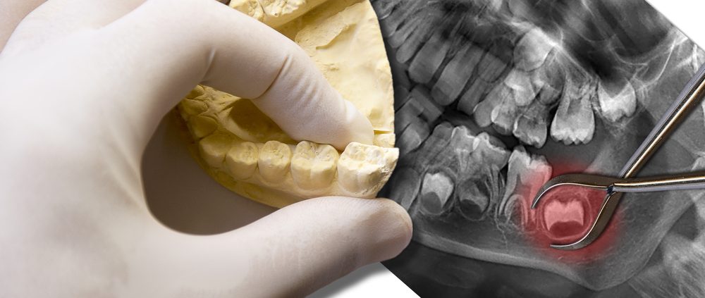 Opération des dents de sagesse - Extraction des dents de sagesse