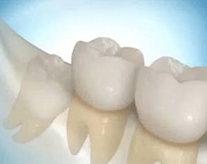 Dents-de-sagesse