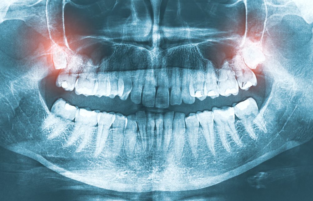 Maux de tête : pensez aux dents de sagesse !