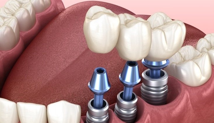 implant dentaire ou prothese dentaire