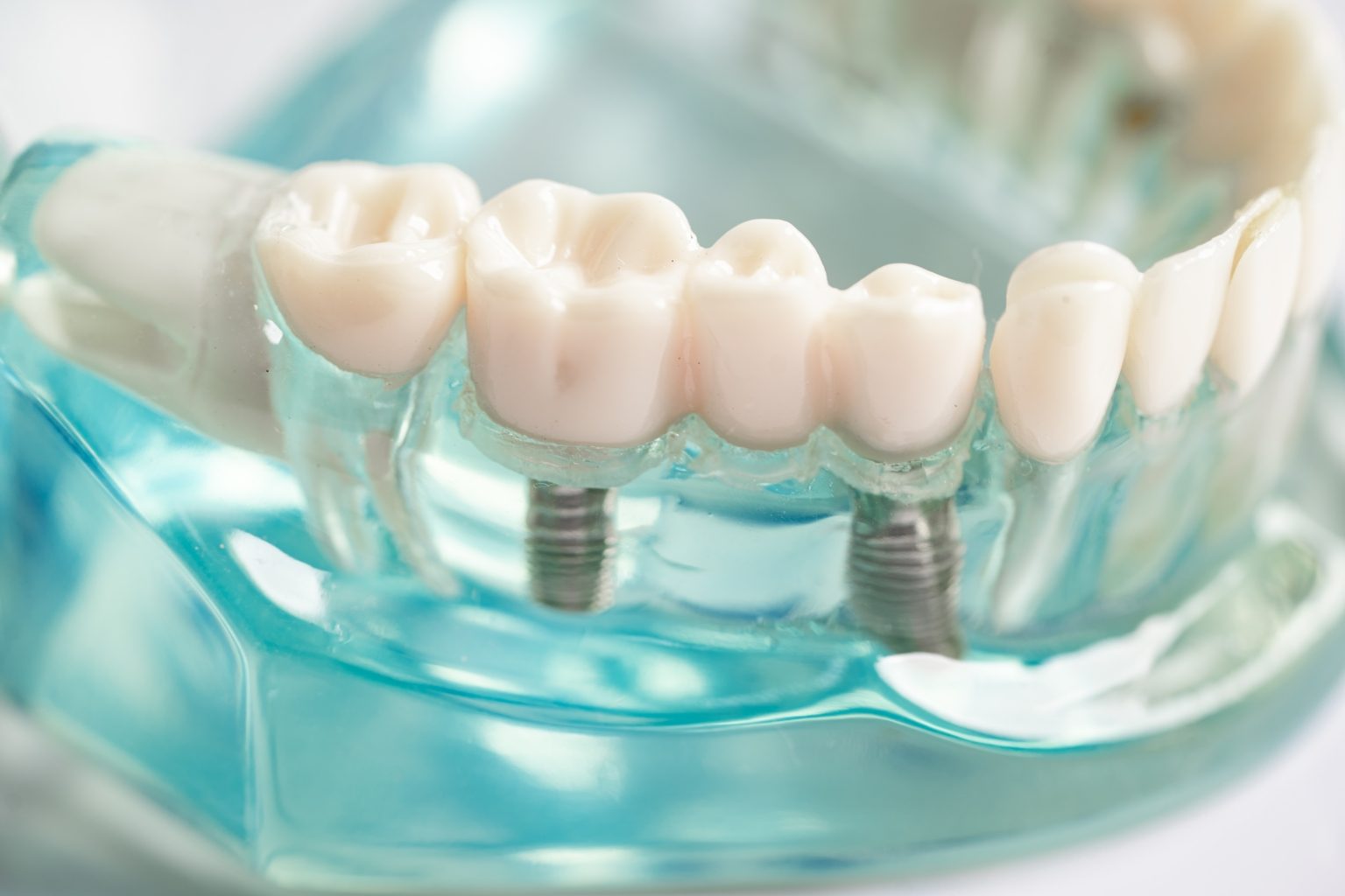 Implant dentaire titane ou zircone, quelles différences — free download