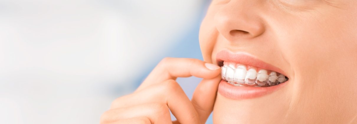 Traiter l'apnée du sommeil par les gouttières: avantages
