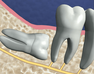 Extractions-de-dents-de-sagesse