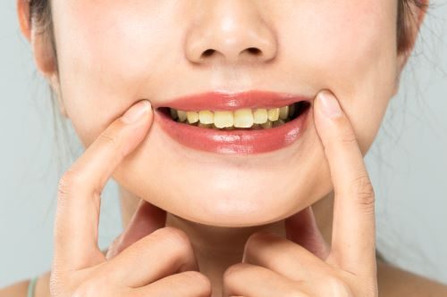 Jaunissement des dents et coloration de l'émail dentaire