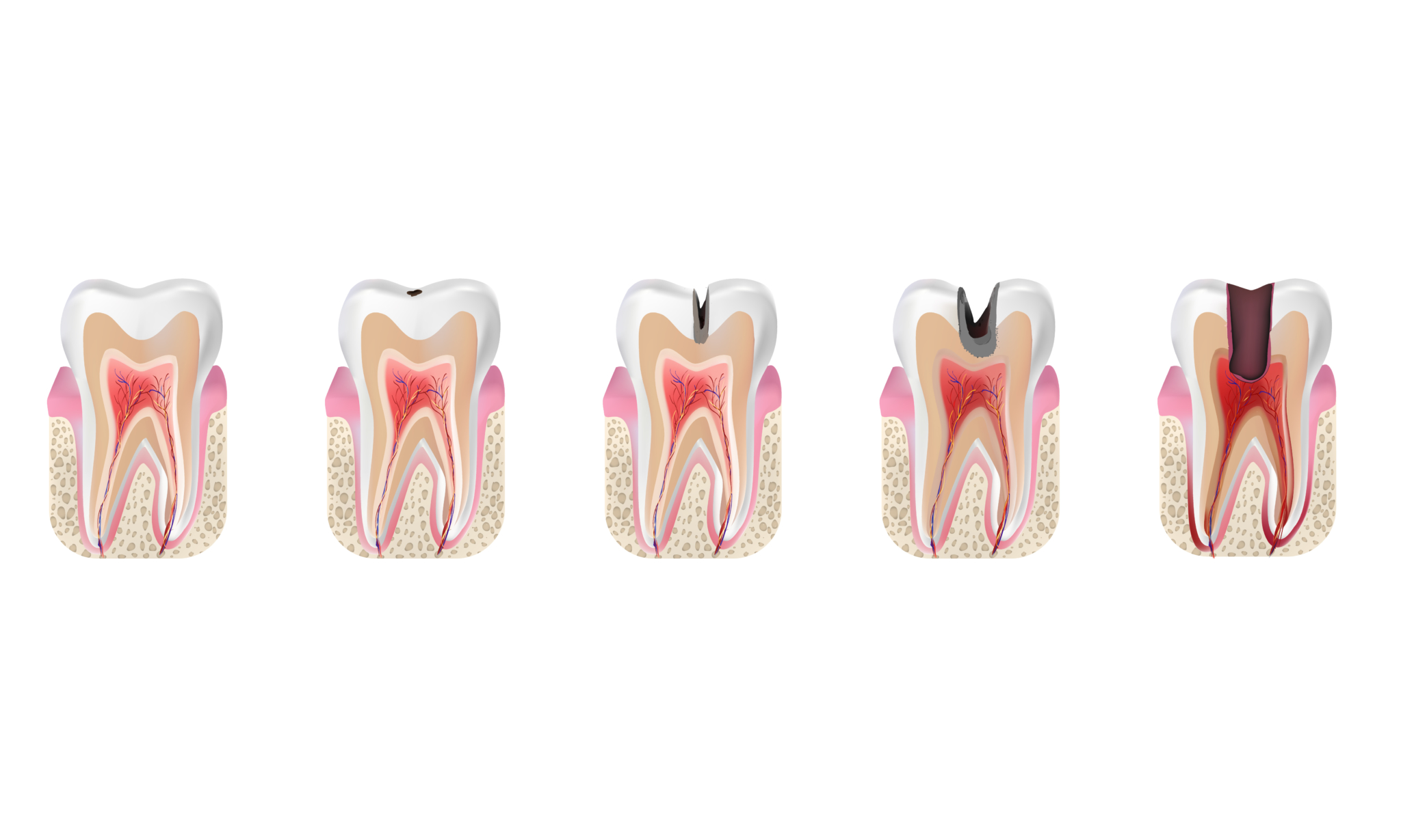 Carie symptômes et conséquences de dents cariées non soignées — free download