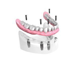 Mise-en-place-des-implants-dentaires 2