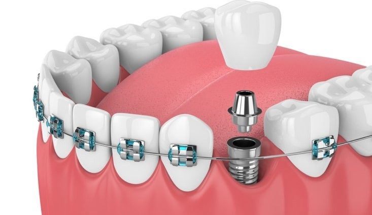 comptabilité orthodontie et implant dentaire