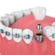 comptabilité orthodontie et implant dentaire