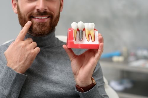 Causes du rejet d'implant dentaire