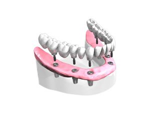 Pose d un bridge complet sur implants dentaires All-on-6