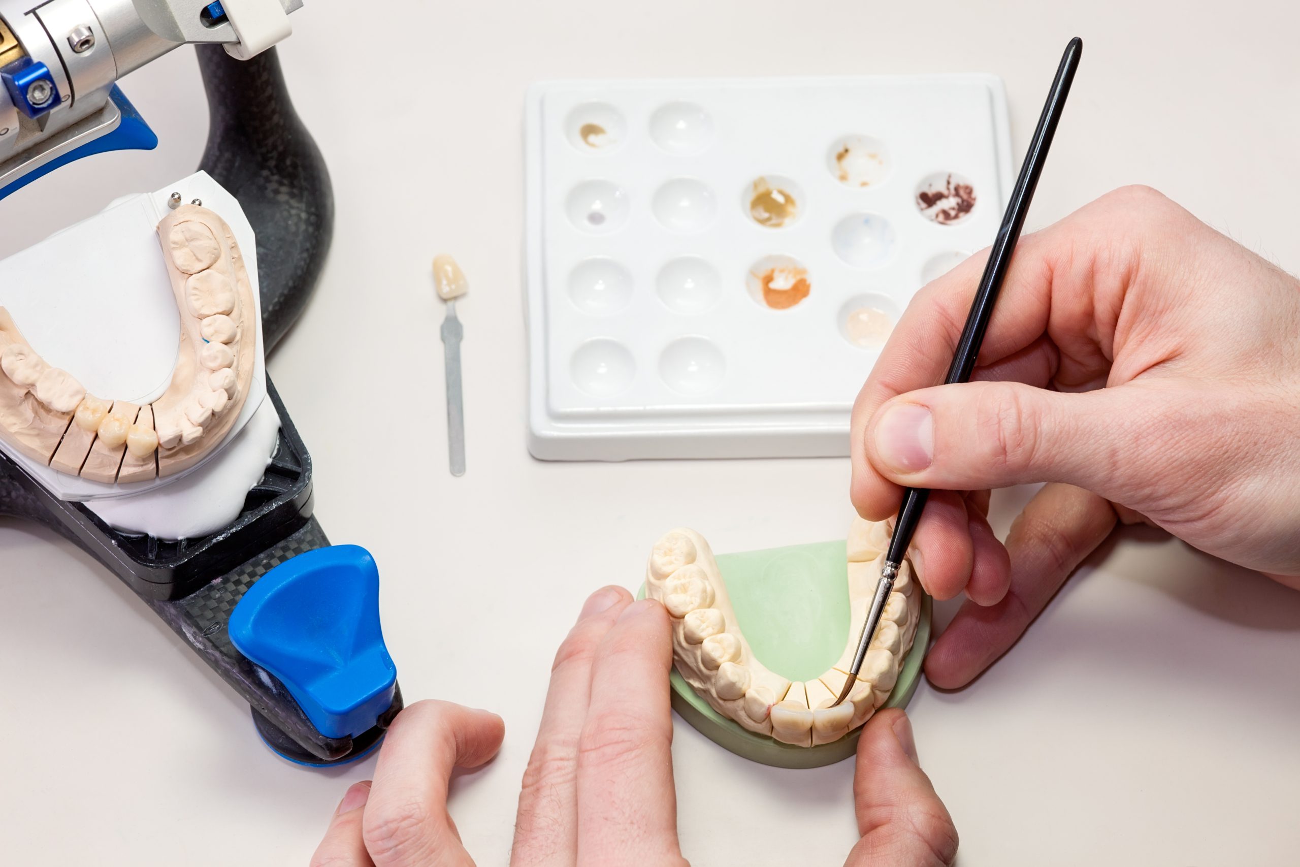 Prothèse dentaire fixe sur implant: confection