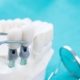 Qu’est-ce que la prothèse fixe sur implant