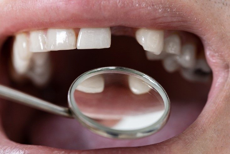 dent manquante - implant ou prothese
