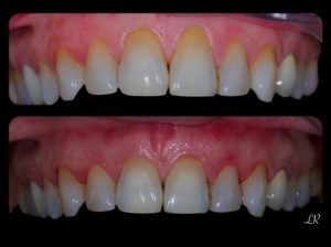 Recouvrements radicules comparaison