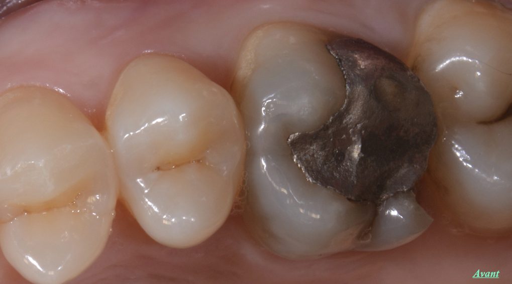 Remplacement couronne dentaire : pourquoi faut-il changer ?
