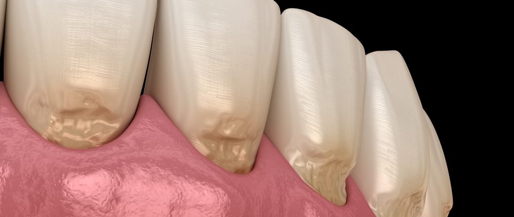 Quels sont les signes d'une abrasion dentaire ?