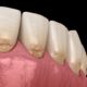 Quels sont les signes d'une abrasion dentaire ?