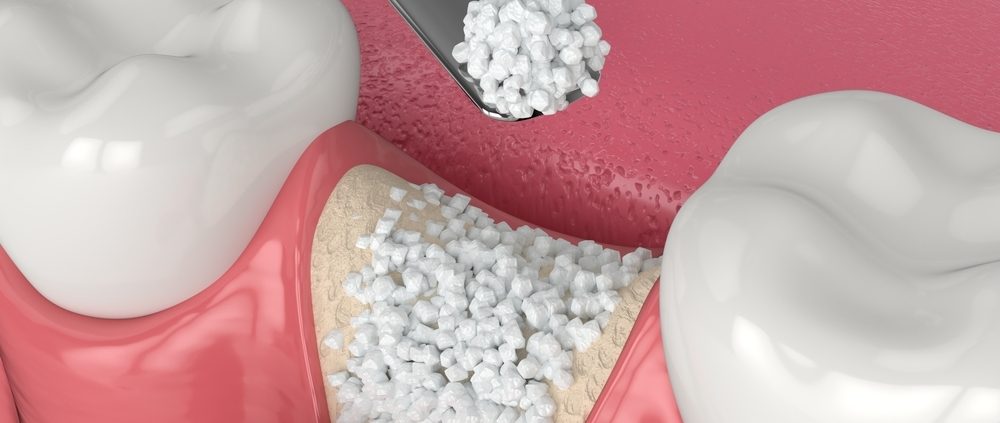 Biomatériaux utilisés pour une greffe osseuse