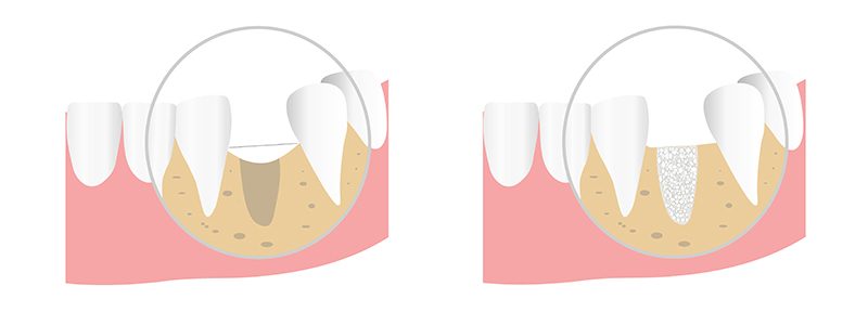 chirurgie guidée implant dentiste