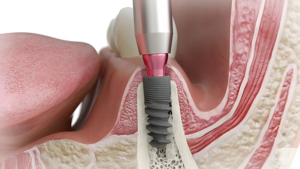 Le comblement osseux précède la pose d'un implant dentaire