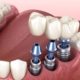 difference implant prothese dentaire