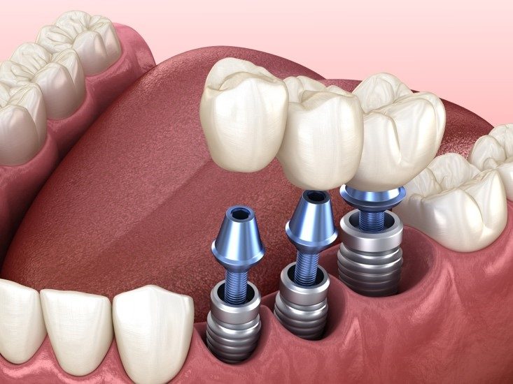 Prothèse dentaire fixe - Dentier, Bridge, Implant, Couronne - Prix et Usage