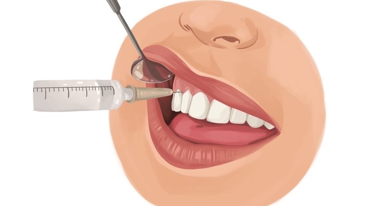 QUELLES SONT LES DIFFERENTES METHODES D’ANESTHESIE DENTAIRE