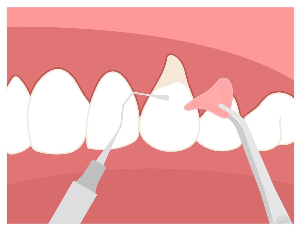 Etapes de la gingivoplastie
