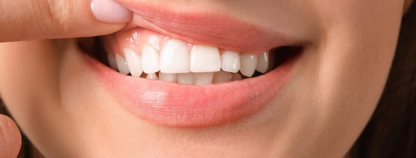 Gencive fragile : cause