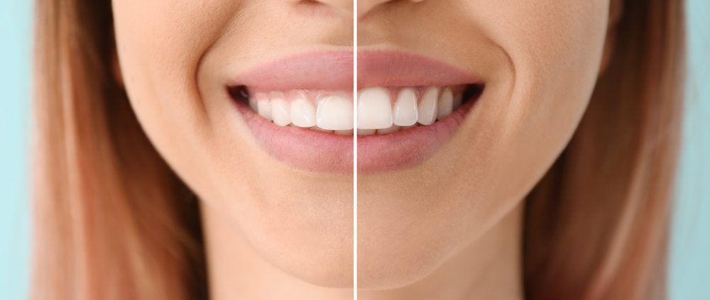 Gingivoplastie: cas avant et après l'opération