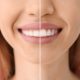 Gingivoplastie: cas avant et après l'opération