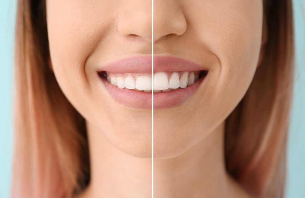 Gingivoplastie: cas avant et après l'opération