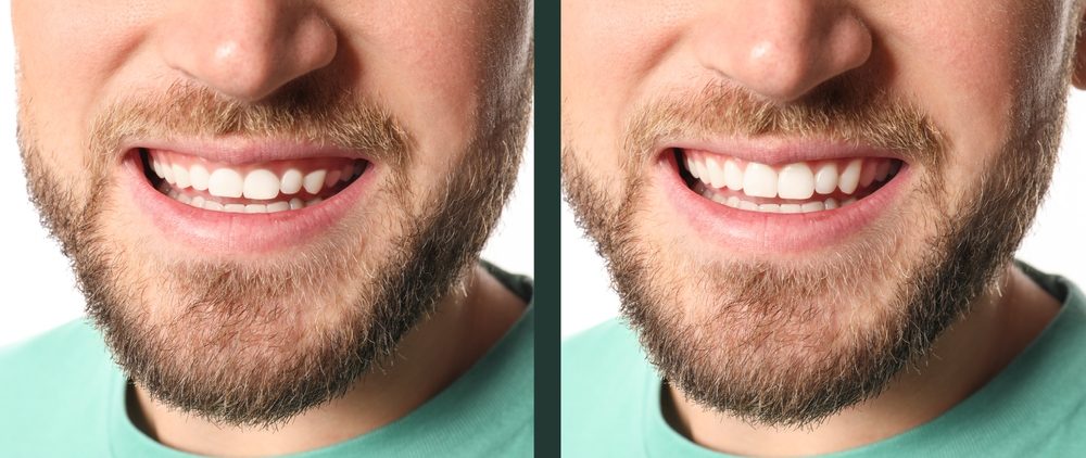 Définition de la gingivoplastie