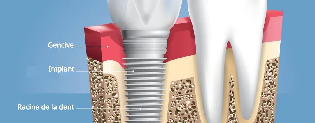 vue transversale d'un implant dentaire