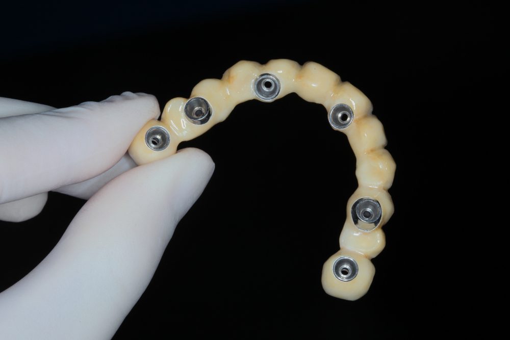 Implant all on 6