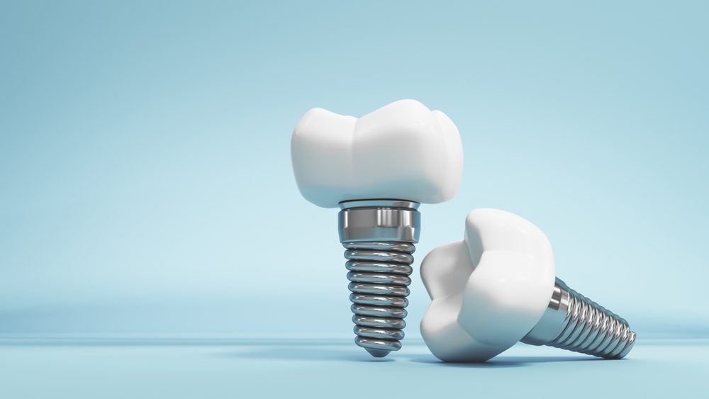 Existe-t-il un âge minimum pour poser un implant dentaire ?