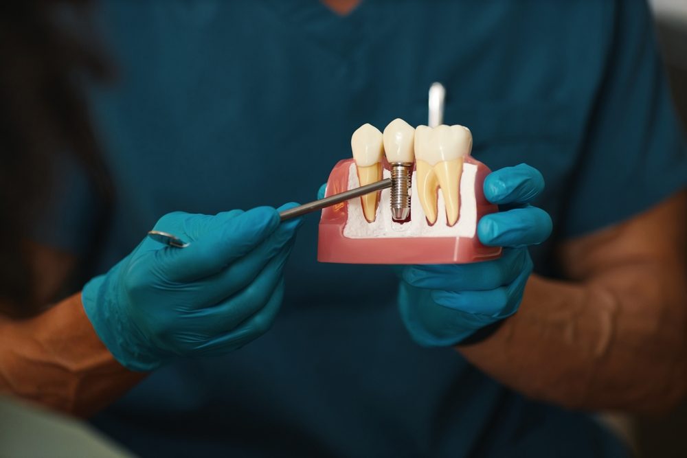 Implant dentaire : existe-t-il un âge minimum ?