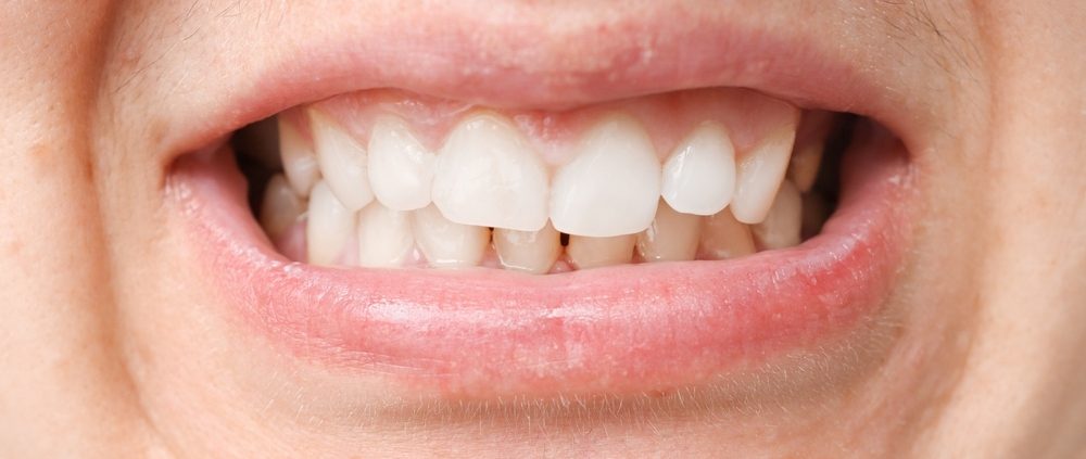 Qu'est-ce que la malocclusion dentaire ?