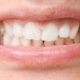 Qu'est-ce que la malocclusion dentaire ?