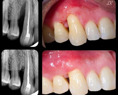 orthodontie avant après