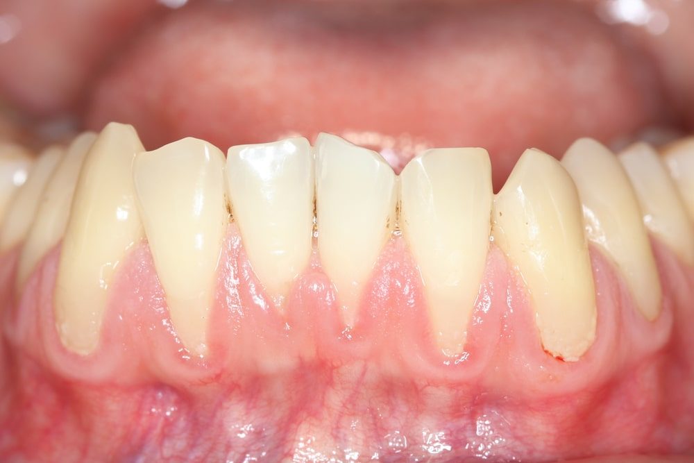 Déchaussement des dents - parodontite