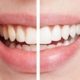 différence dent avec et sans plaque dentaire